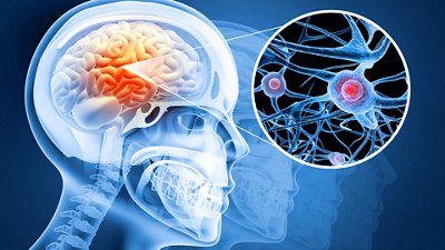 Photo of a virtual scan of a brain and a zoom on TBI Traumatic Brain Injury